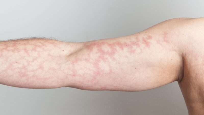 Co znamená a jak vypadá mramorová kůže