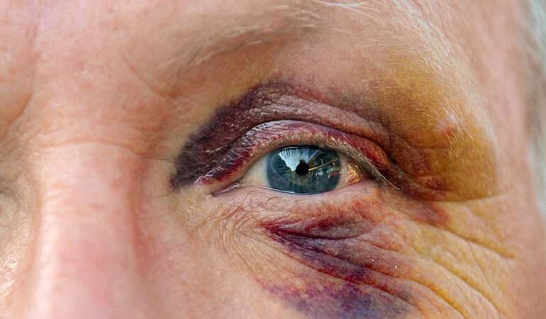 Monokl na oku – Za jak dlouho zmizí a co na monokl pomáhá?